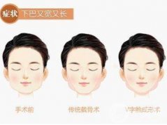 下頜角手術(shù)術(shù)后護理要注意哪些？