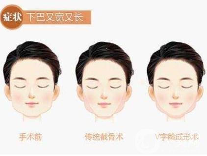 下頜角手術(shù)術(shù)后護(hù)理要注意哪些？