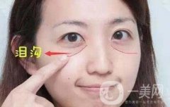 玻尿酸豐淚溝有危險嗎？能管多久？
