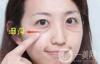 玻尿酸豐淚溝有危險嗎？能管多久？