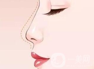 硅膠隆鼻假體取出術(shù)后護理注意事項有哪些呢?