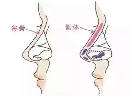 硅膠隆鼻假體取出術(shù)后護理注意事項有哪些呢?