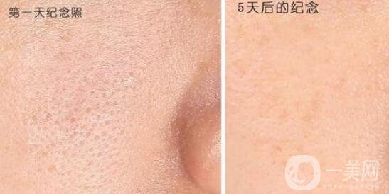 收縮毛孔