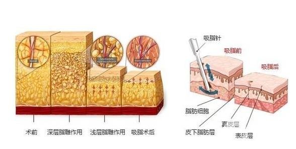 360度吸脂的手術(shù)需要多少錢？