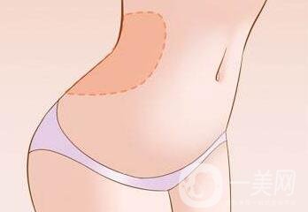 腹壁整形多少錢？費(fèi)用詳細(xì)解說
