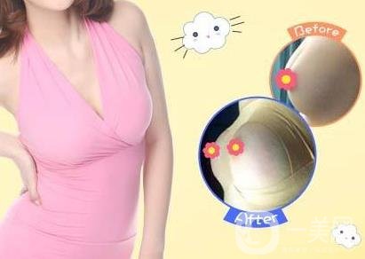 娜高豐胸假體好不好？需要多少錢？