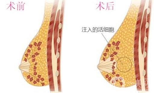 自體細(xì)胞豐胸*果自然嗎？要恢復(fù)多久？