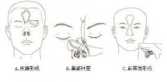 全鼻再造術(shù)找誰(shuí)做?國(guó)內(nèi)哪些醫(yī)生做得好?