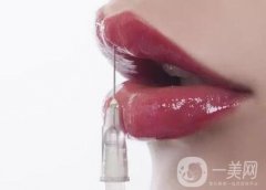 玻尿酸豐唇珠能夠保持多久？需要繼續(xù)注射嗎？