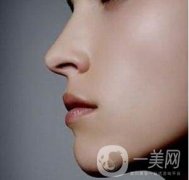 骨粉隆鼻后遺癥是什么樣的？