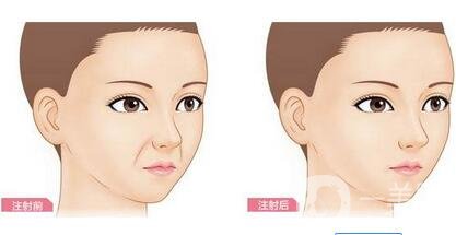 注射豐鼻唇溝*果*嗎？能立馬*果嗎？