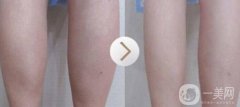 注射瘦腿有用嗎?會(huì)不會(huì)有后遺癥出現(xiàn)?