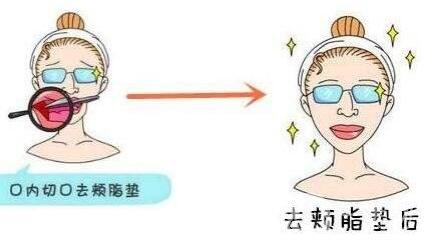 去頰脂墊價(jià)格貴嗎？大概價(jià)位是多少？