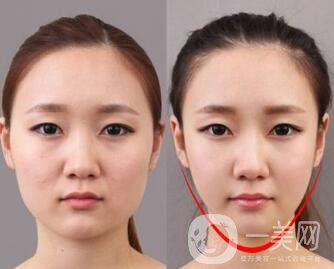去頰脂墊有副作用嗎？術(shù)后如何護(hù)理可以減小副作用？
