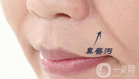 玻尿酸豐鼻唇溝能維持多長(zhǎng)時(shí)間?