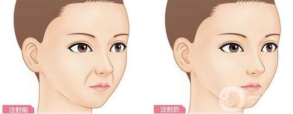 玻尿酸豐鼻唇溝能維持多長(zhǎng)時(shí)間?
