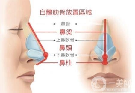 韓式肋骨隆鼻手術(shù)多少錢？*果怎樣？