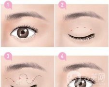 *需要拆線(xiàn)嗎？多長(zhǎng)時(shí)間可以碰水？