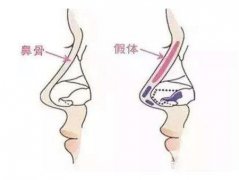 假體隆鼻整型術(shù)術(shù)前準(zhǔn)備有哪些？