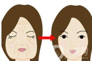 冰電波拉皮除皺*果如何？有哪些優(yōu)點(diǎn)？