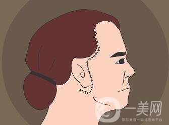 冰電波拉皮除皺*果如何？有哪些優(yōu)點(diǎn)？