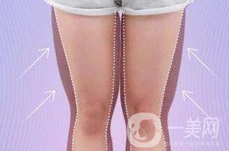 大腿環(huán)形吸脂多久恢復(fù)？會有疤嗎？