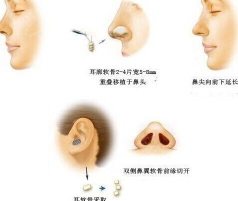 鼻尖美容術(shù)是怎樣做的?詳細解析公布
