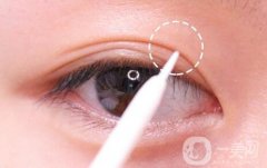 做雙眼皮手術(shù)過程是怎樣的?需要多久?