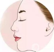 如何讓鼻梁變高？可以注射玻尿酸嗎？