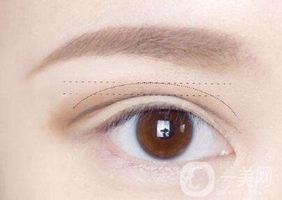 三點(diǎn)定位雙眼皮手術(shù)后應(yīng)該注意些什么？