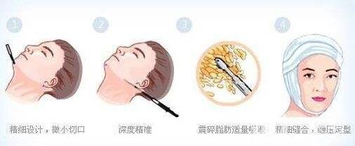面部吸脂