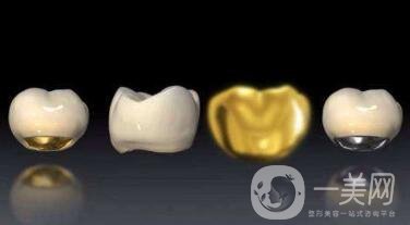 貴金屬烤瓷牙有哪些種類？