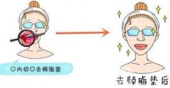 去頰脂墊價(jià)格貴不貴?收費(fèi)情況說(shuō)明