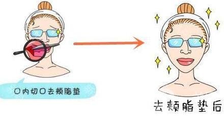 去頰脂墊價格貴不貴?收費情況說明
