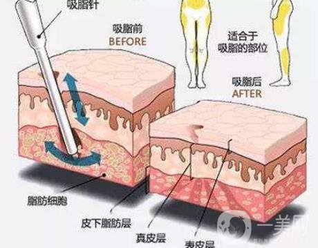 全身抽脂減肥價(jià)格大概要多少錢(qián)？