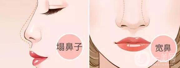 鼻頭縮小手術(shù)價錢是多少?有哪些縮小鼻頭的方法