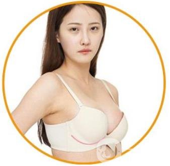 娜綺麗隆胸多久變軟？怎么加速變軟？