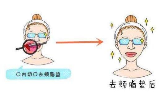 去頰脂墊*果怎么樣？*嗎？