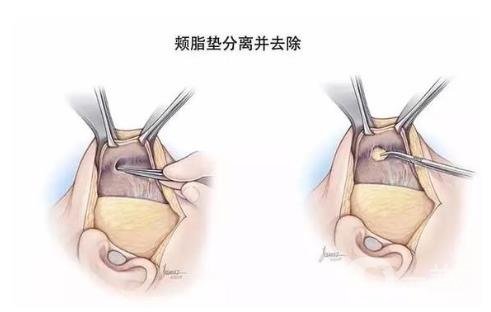 去頰脂墊*果怎么樣？*嗎？
