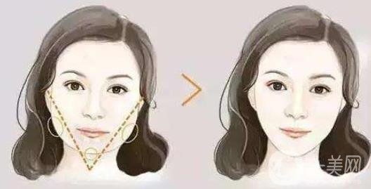 去頰脂墊*果怎么樣？*嗎？