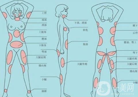 全身抽脂減肥多少錢？貴嗎？