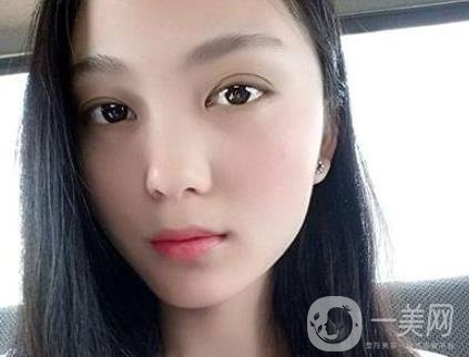 吸雕雙眼皮手術(shù)是什么？是埋線嗎？