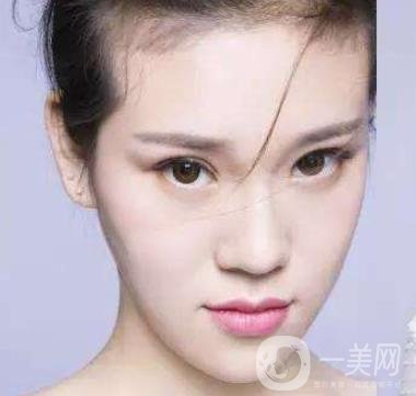像素激光去痘的*果好嗎？會反彈嗎？