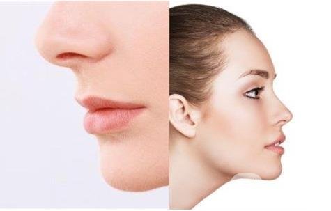 怎樣讓鼻子變高？隆鼻可以讓鼻子變高嗎？