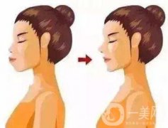 雙頜前突帶牙套可以矯正嗎？