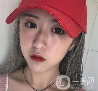 西安葉子整形美容醫(yī)院雙眼皮