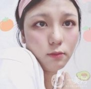 六盤水友好整形醫(yī)院價格表及雙眼皮術后果分享
