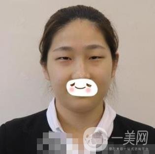 濟(jì)南旭美整形醫(yī)院靠譜嗎?附雙眼皮案例和全新價格表