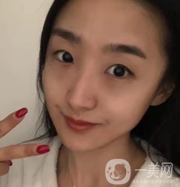 吉大一院整形外科價(jià)格表明細(xì)公布，隆鼻紀(jì)實(shí)案例分享