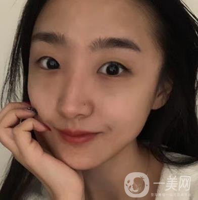 吉大一院整形外科價(jià)格表明細(xì)公布，隆鼻紀(jì)實(shí)案例分享